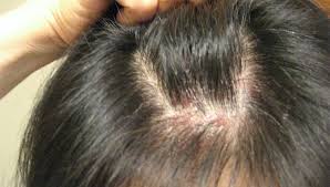 Hair care tips for scalp psoriasis