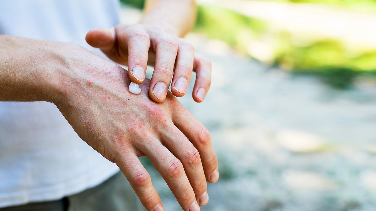 Why peeling psoriasis scales can do more harm than good